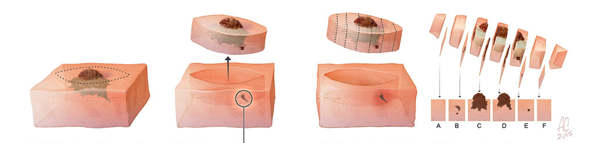 Diagrama da cirurgia convencional: a peça retirada é cortada verticalmente e apenas algumas fatias são examinadas.