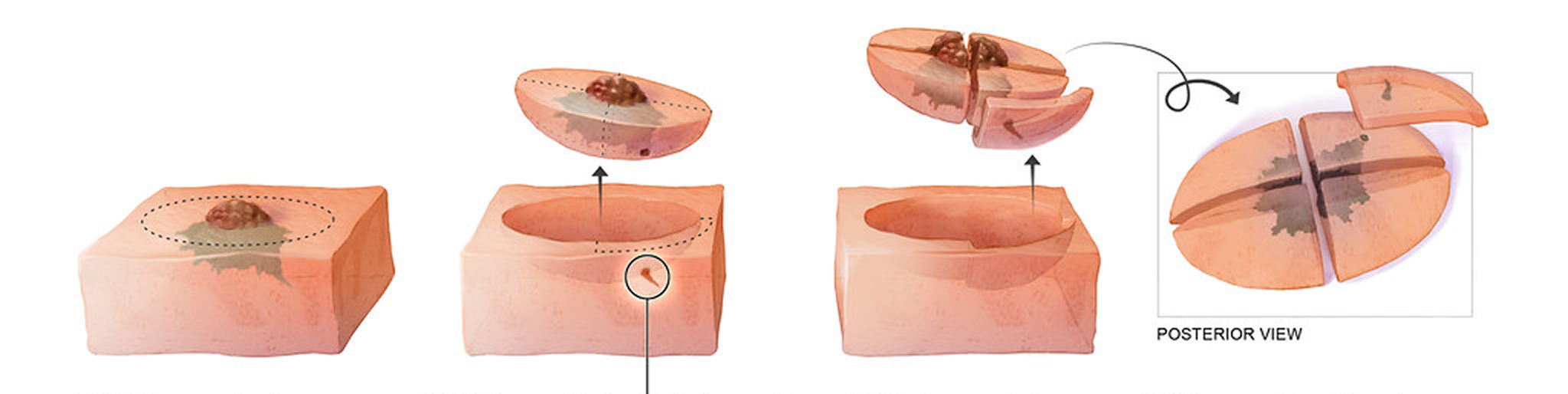 Diagrama da cirurgia de Mohs: a peça é cortada horizontalmente e toda a margem lateral e profunda é examinada.